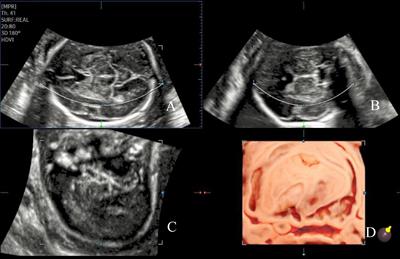 Ultrasound assessment of insular development in adequate-for-gestational-age fetuses and fetuses with early-onset fetal growth restriction using 3D-ICRV technology